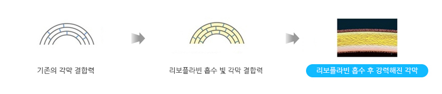리보플라빈 픕수 후 강력해진 각막